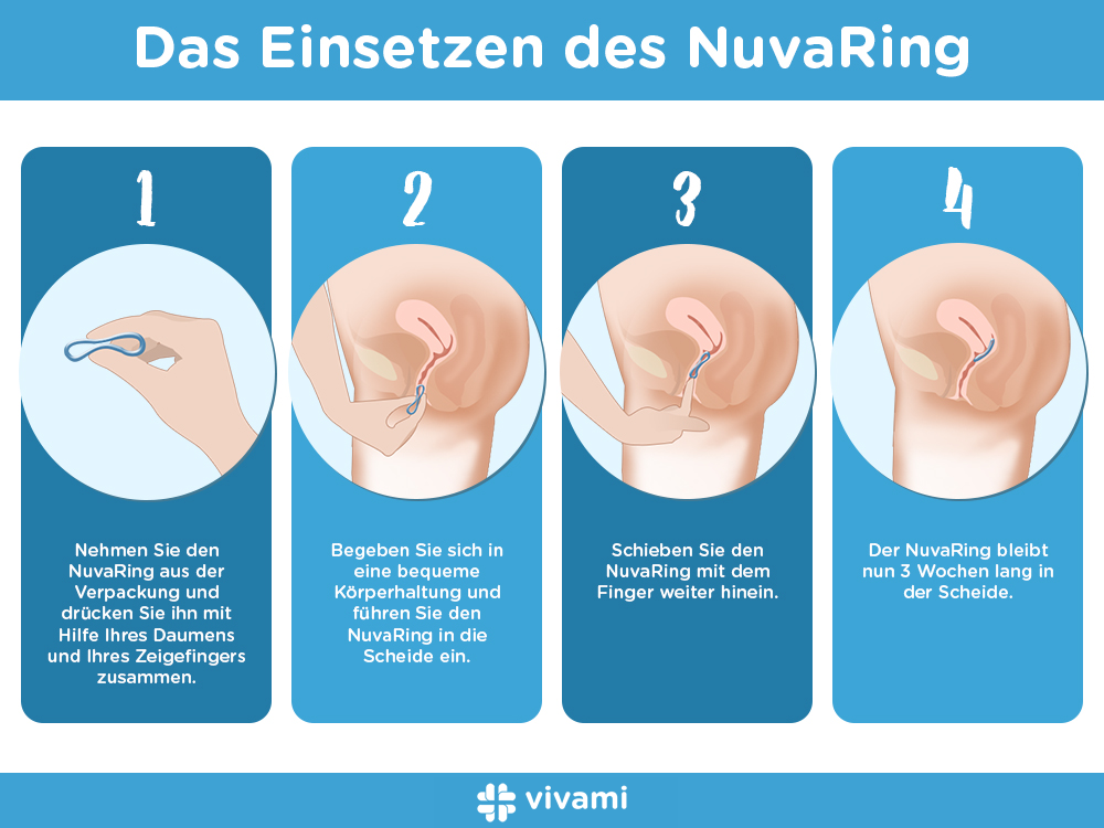 Das Einsetzen des NuvaRing