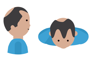 Hairloss -4 Kreisrund