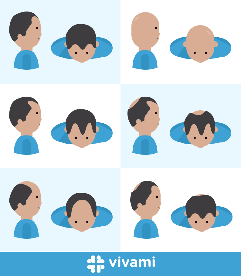 Hairloss -type _all _1.0